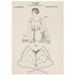 Brassiere patent drawing by M P Jacob.